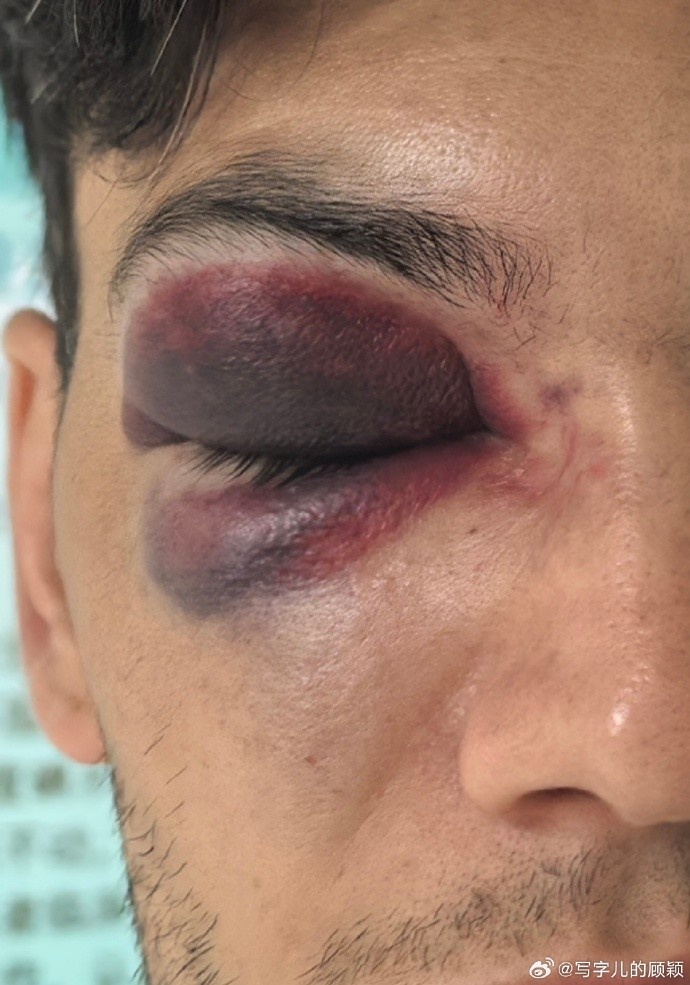 薩爾瓦多最新照片顯示眼部淤血嚴重，記者：他今天繼續去醫院