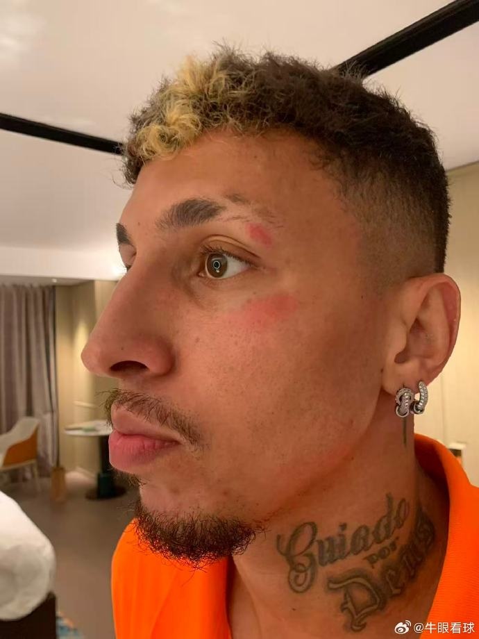 記者：克雷桑頭部被踢了一下，換下他是用了腦震蕩條款